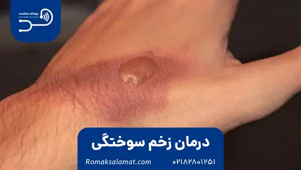درمان زخم سوختگی