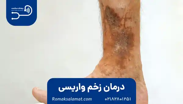 درمان زخم واریسی